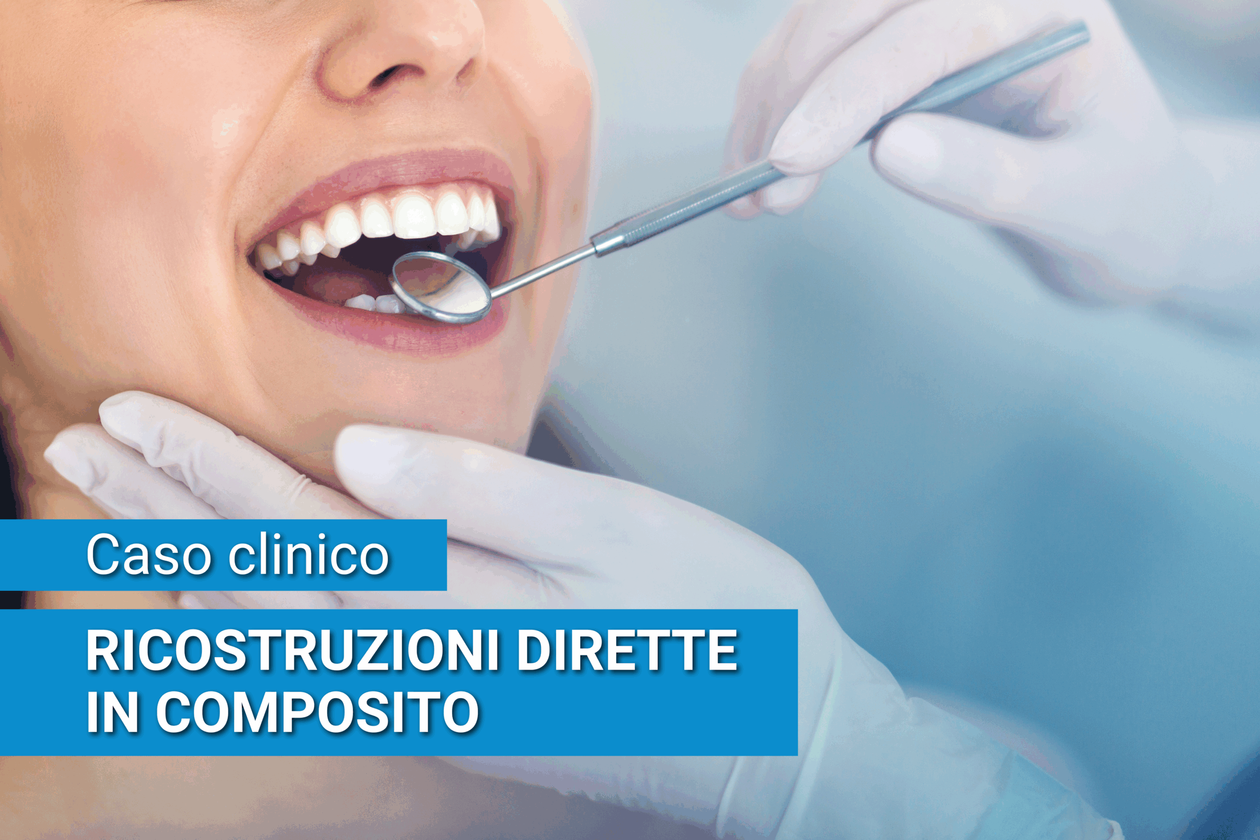 Al momento stai visualizzando Caso estetico: ricostruzioni dirette in composito