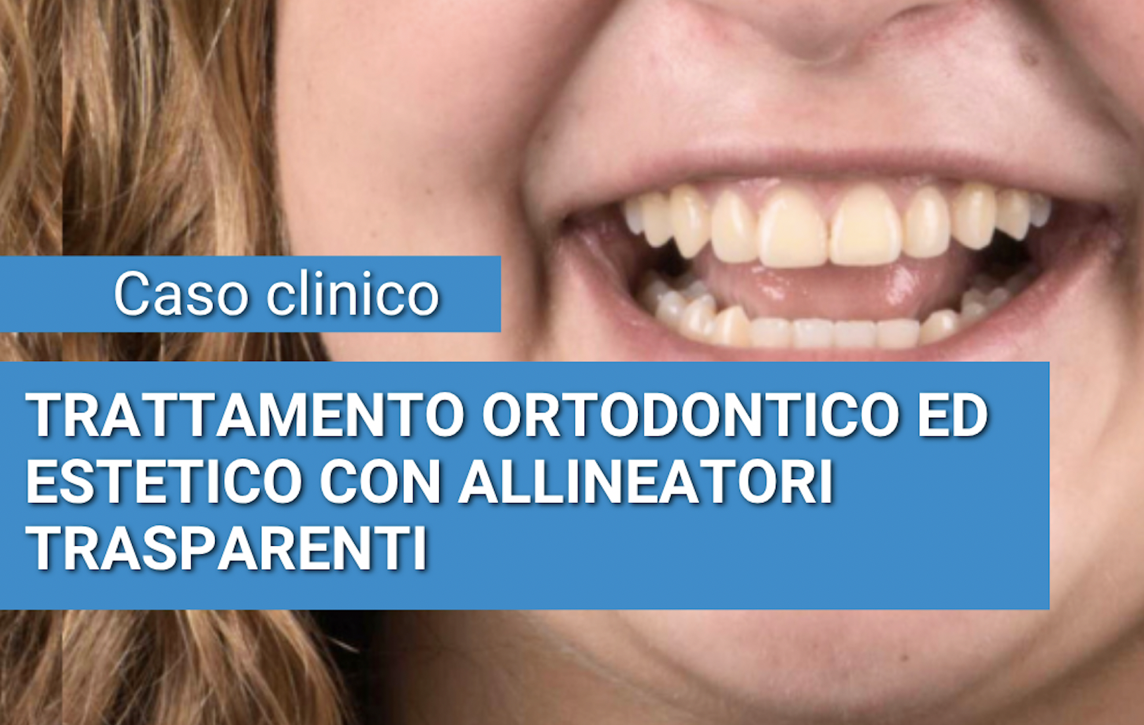 Al momento stai visualizzando CASO CLINICO: TRATTAMENTO ORTODONTICO ED ESTETICO CON ALLINEATORI TRASPARENTI